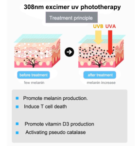 Láser Excimer Kernel para Vitiligo en Manos, Lámpara UVB Excimer de 308nm, Dispositivo de Fototerapia para Uso Doméstico, Curación de Psoriasis y Vitiligo - Product Image 6