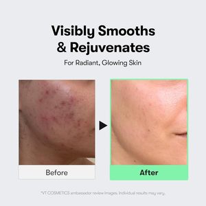 VT CICA Reedle Shot 100 Siero 50ml per Microneedling, Cura dei Pori, Esfoliante per la Cura della Pelle del Viso - Product Image 5