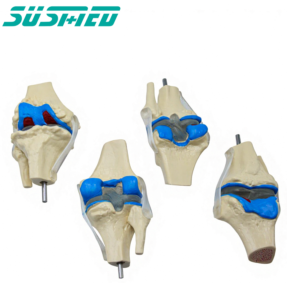 4 Stage Osteoarthritis Knee Model, Human Joint Anatomical Model ...