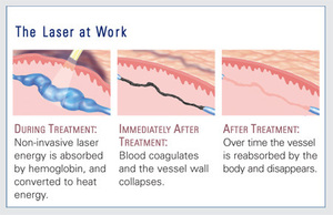 Élimination portable des varices et des télangiectasies au laser 980nm/1470nm – Traitement des capillaires et des angiomes de la <span class=keywords><strong>cerise</strong></span> - Product Image 2