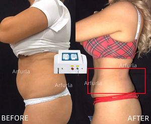 Lasermengangkat serat Endolaser portabel 1470nm + 980nm, peralatan Kecantikan pengurang lemak untuk kelopak wajah bawah - Product Image 4