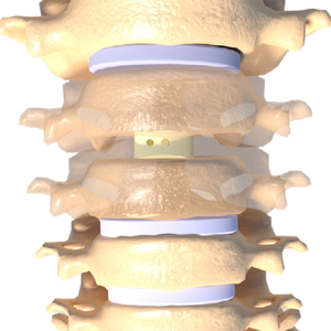 <span class=keywords><strong>Cage</strong></span> cervicale antérieure <span class=keywords><strong>PEEK</strong></span> de haute qualité pour chirurgie spinale, vente en gros, minimal invasif - Product Image 1