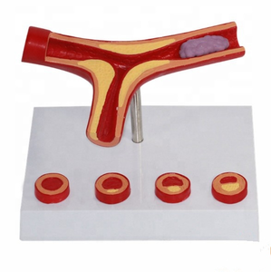Science médicale de haute qualité et meilleur prix, modèle de <span class=keywords><strong>pathologie</strong></span> de vaisseau sanguin de trombose - Product Image 4
