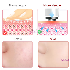 Rouleau de microdermabrasion électrique DrPen N2-<span class=keywords><strong>C</strong></span> avec 5 niveaux de réglage de la profondeur Longueur des aiguilles : 0,2-2,5 mm Embouts d'aiguilles - Product Image 5