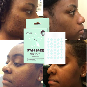 Nuevo Parche para el Acné Star Face, Ayuda a Absorber el Exceso de Grasa y a Reducir la Apariencia del Acné, Parche para el Acné OEM MOOYAM - Product Image 1