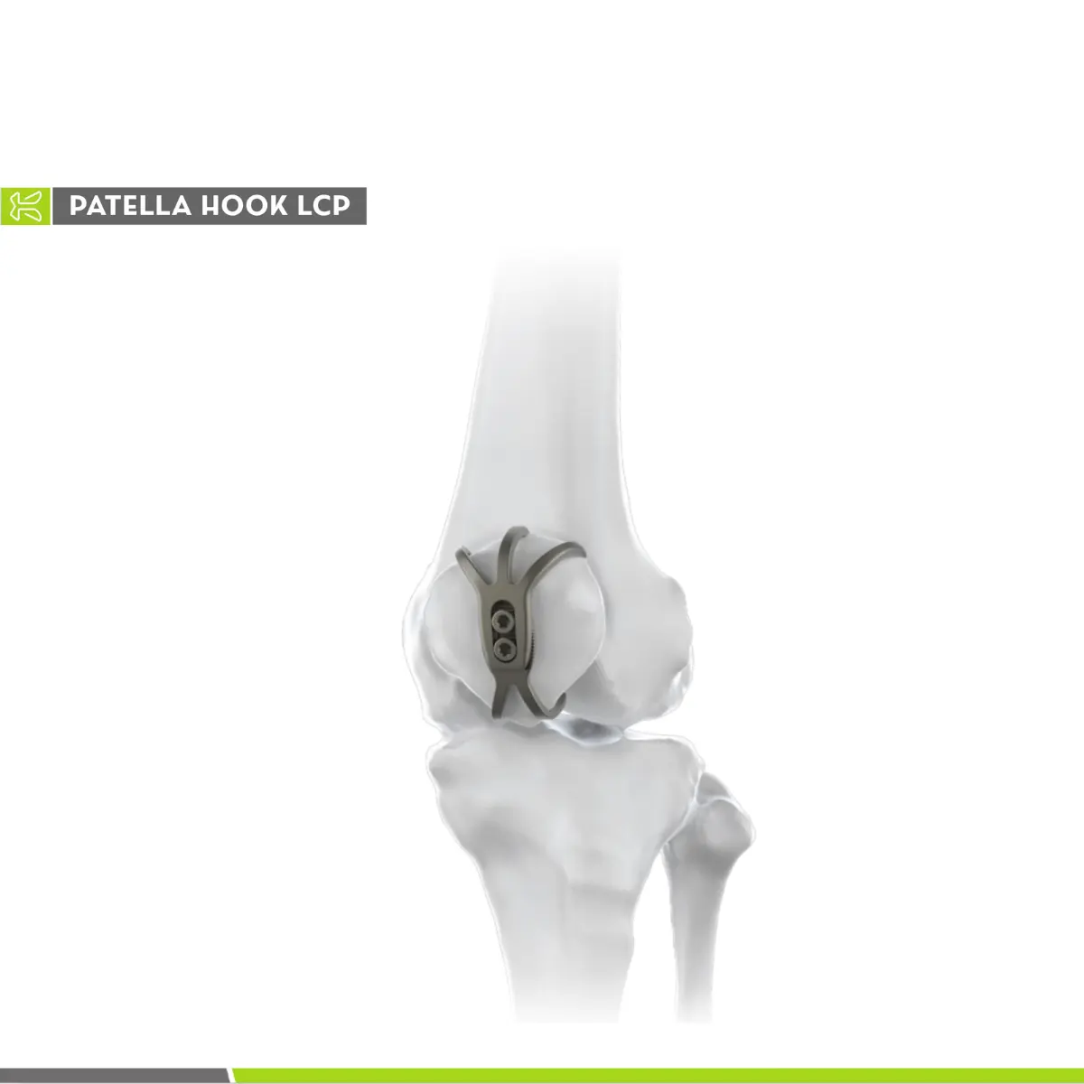 パテラクロープレートパテラフックプレート整形外科用外傷骨インプラント下肢骨膜外傷学契約メーカー