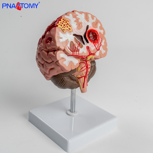 Modelo Anatômico do Cérebro PVC Hemorragia Cerebral e Malformação Arteriovenosa Patologia - Product Image 6