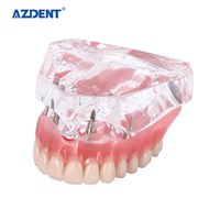 Modèle d'implant dentaire pour la restauration de prothèse dentaire avec implants supérieurs