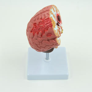 SCIEDU Modelo De Anatomia Do Cérebro Humano Hemorragia Artéria Cerebral Malformação Arteriovenosa Cerebral Patologia Cerebral Modelo Cerebral - Product Image 4