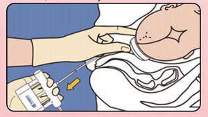 Forniture chirurgiche di <span class=keywords><strong>ostetricia</strong></span> e <span class=keywords><strong>ginecologia</strong></span> attrattore testa-up monouso - Product Image 5