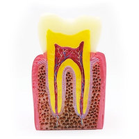 Étude d'usine directe dentiste anatomique dent cariée orale modèle de comparaison des maladies dentaires courantes