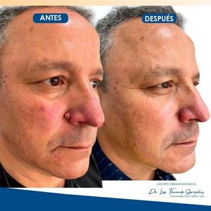 IBeaLee Fórmula Natural, Removedor de <span class=keywords><strong>Verrugas</strong></span> y Acrocordones Eficaz, Suero Líquido a Base de Hierbas <span class=keywords><strong>para</strong></span> <span class=keywords><strong>Eliminar</strong></span> Lunares - Product Image 3