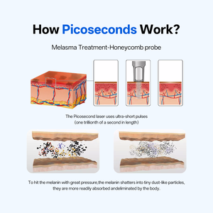 Professional Picosecond Laser Q-Switched NdYAG <strong>Tattoo</strong> &amp; Pigment Removal 1064 532 755nm Skin Whitening Device with 2000W Power - Product Image 5