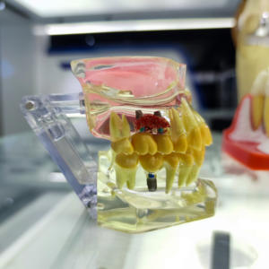 Sistema de Implantes Dentales CANWELL, Superficie S.L.A., Titanio Puro, Kit Quirúrgico, Pilar de Implante <span class=keywords><strong>Dental</strong></span> BL-3 Clase III, Garantía de por Vida - Product Image 3