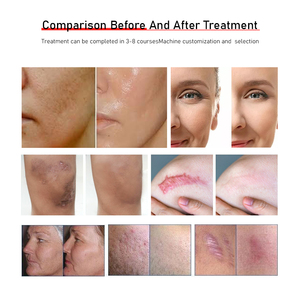 Équipement laser fractionné au CO2 professionnel portable, longueurs d'onde de 10600 nm, beauté, resserrement vaginal, élimination permanente des cicatrices pour - Product Image 6