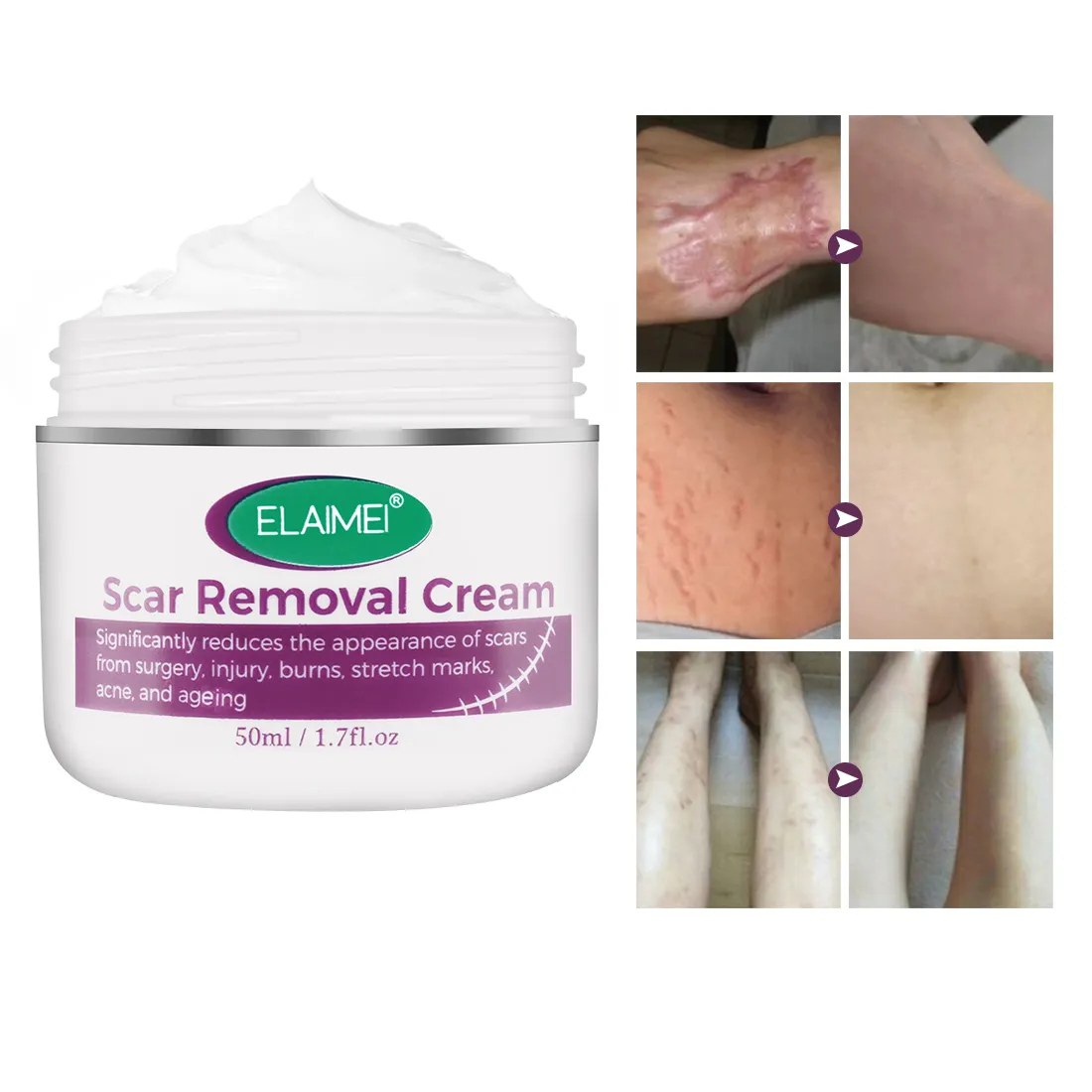 ELAIMEI Crème naturelle à base de plantes pour réparer les marques de boutons d'acné et de vergetures Crème pour enlever les cicatrices du visage