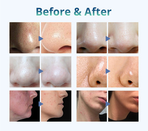 Portable Dermabrasion Face Deep Cleaning Device Facial Skin Care <b>Machine</b> - Product Image 5