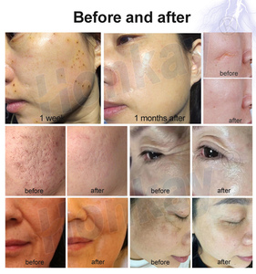 Máquina de Plasma 2 en 1 para Uso en Salón de Belleza 2026, Plasma Anti-Envejecimiento, Eliminación de Manchas, Cicatrices y <span class=keywords><strong>Verrugas</strong></span> <span class=keywords><strong>con</strong></span> Ozono - Product Image 5