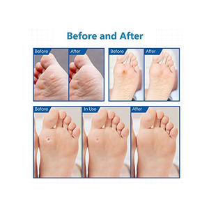 Prodotto Approvato OEM ODM Bestseller 2024 MQ Cerotti per Rimozione Calli con Formula Naturale a Base di Erbe, Senza <span class=keywords><strong>Dolore</strong></span> - Product Image 6