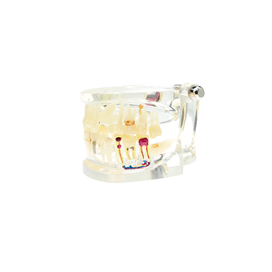 Modèle de dents pour maladies implantaire, conception claire, modèle d'étude des dents implantaire, modèle de pathologie <span class=keywords><strong>dentaire</strong></span> pour usage <span class=keywords><strong>dentaire</strong></span> - Product Image 2