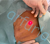 Accessoire laser diode Arfurla 400um 600um 800um pour lipolyse par fibre endolaser et liposuccion Vaser 980nm 1470nm