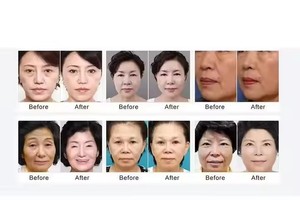 เครื่องฟื้นฟูผิวหน้าและผิวกายความเข้มข้นสูง 2 in 1 พร้อมฟังก์ชั่นกระชับช่องคลอด จัดส่งรวดเร็ว - Product Image 3