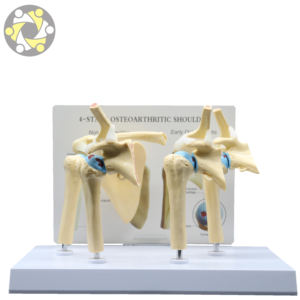 Médico enfermo 4 etapa osteoartritis <span class=keywords><strong>hombro</strong></span> modelo de enseñanza - Product Image 3