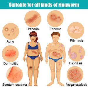 20g Salep Jerawat Dermatitis Skrotum Eksim Pityriasis Urtikaria Krim - Product Image 4