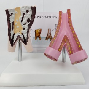 Modelo de Comparación de Vasos Sanguíneos Normales <span class=keywords><strong>y</strong></span> Vasos Dañados por el Tabaco, Estructura Vascular, Enseñanza Anatómica, <span class=keywords><strong>Ciencia</strong></span> Popular - Product Image 5