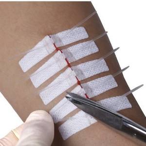 Cinta Quirúrgica Adhesiva Transparente de un Solo Uso Medco, Sin Suturas, para Cesárea - Product Image 5