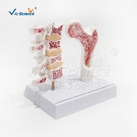 Modelo de Lesión de Osteoporosis en 2 Partes: Columna Vertebral y Fémur Proximal Patológicos, PVC Pintado a Mano, Ideal para la Educación del Paciente