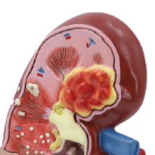 Modelo de Riñón de Tamaño Natural ADA de Doble Cara (Normal y con Patologías) A739, Modelo Anatómico para Ciencias Médicas y Escuelas - Product Image 2