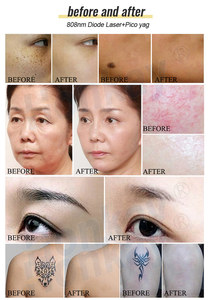 Máquina multifuncional 2 en 1 de 808nm Pico Yag con pantalla táctil de 10.4 pulgadas para eliminación de tatuajes y depilación - Product Image 6