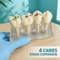 Modèle de classification des caries dentaires pour démonstration de scellement des fissures et des cavités, destiné aux cliniques et à l'enseignement de la santé bucco-dentaire en milieu scolaire, base transparente en ABS