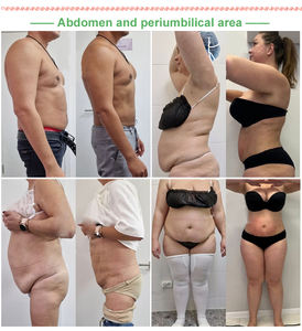 Equipo de Liposucción <span class=keywords><strong>Vaser</strong></span> Lipo, Cánula de Adelgazamiento de Grasa, Láser de Diodo de 980/1470 nm, Lipólisis, Máquina de Lifting Endoláser - Product Image 5