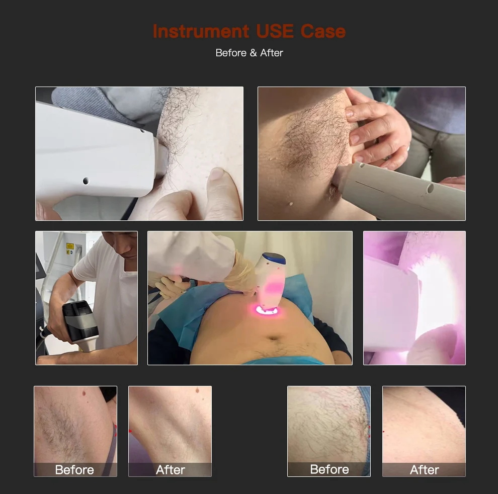 pico diode laser combo machine