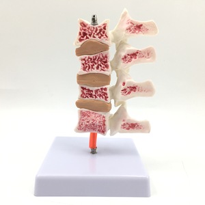 Simulation pédagogique de l'ostéoporose humaine, de la colonne vertébrale, des vertèbres lombaires, du squelette, de la structure osseuse, de la pathologie, des intervertèbres lombaires - Product Image 1