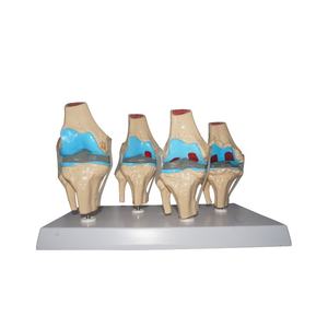 แบบจำลองข้อเข่าเสื่อมขั้นที่4ของมนุษย์รูปแบบทางพยาธิวิทยาของข้อเข่า - Product Image 1