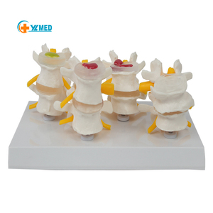Modelo de degeneración de vértebras lumbares de 4 etapas de ciencia médica modelo de columna vertebral humana modelo de disco intervertebral Lumbar - Product Image 1