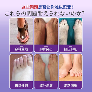 Iwai Jackson Pharmazeut ische Salbe Kinder fuß Daumen Ectropion Corrector Chinesisches Pflaster für Gelenk knochen - Product Image 3