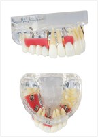 Modèle d'implant dentaire anatomique Danter A2006 avec matériau en résine pour la restauration dentaire, usage professionnel