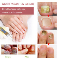 Huile Réparatrice pour Ongles EELHOE Marque Privée – Traitement Anti-Fongique pour Ongles Jaunes – Liquide Fortifiant pour Soin des Ongles 3ml – Hydratant Doux pour les Mains