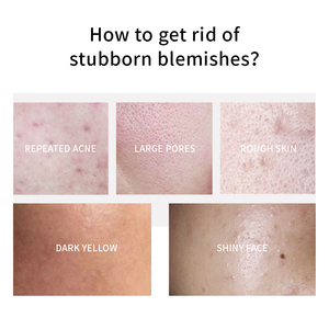 Suero orgánico para el cuidado de la piel, líquido blanqueador antiacné con ácido salicílico para pieles sensibles - Product Image 2