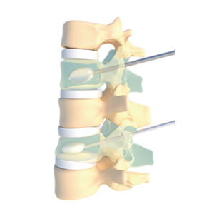 Aiguille de guidage pour vertébroplastie thoracique par ponction métallique, ponction couche par couche, aiguille perforatrice pour le corps vertébral - Product Image 1