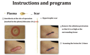 Máquina Portátil de Plasma Dorado para Eliminar Cicatrices, Manchas y Arrugas, Uso Doméstico y Profesional, 6 Puntas, Reafirmante - Product Image 5