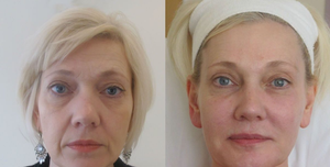 Prix de gros CE BDDE <span class=keywords><strong>Acide</strong></span> <span class=keywords><strong>hyaluronique</strong></span> réticulé injectable pour comblement cutané, anti-rides, amélioration du visage OEM ODM - Product Image 6