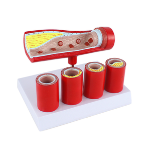 Modello di arteria coronaria cardiovascolare a strati trasparenti con marcatori patologici - Product Image 2