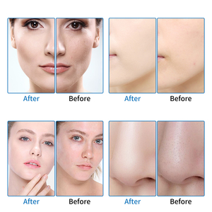 Máquina de Microdermoabrasión Lifit, Cuidado Facial Reafirmante, Manchas Pálidas, Exfoliante para Piel Joven, Reduce Poros, Máquina de Belleza Hydra - Product Image 3