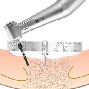 Autoclavable Manual <strong>Dental</strong> <strong>Implant</strong> Locating <strong>Guide</strong> <strong>Surgical</strong> Positioning 2-Angle Ruler for Dentist - Product Image 6