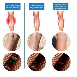 Diskon besar krim pijat intravena krim pereda penenang kaki pembuluh darah tonjolan pereda nyeri Choroid pijat pembuluh varises - Product Image 6